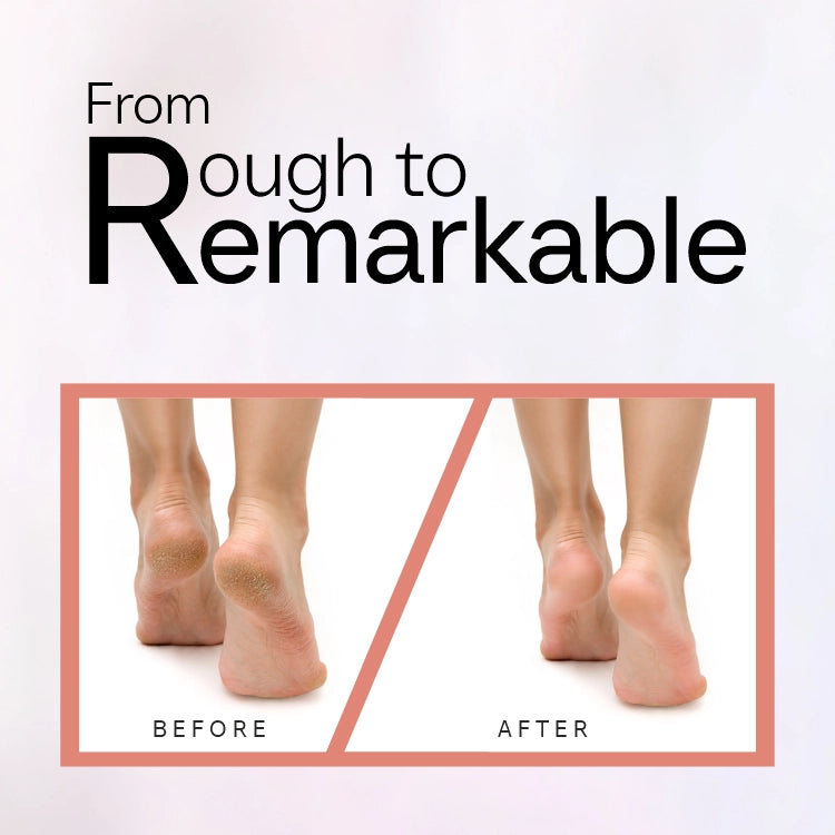 Electronic Callus Remover