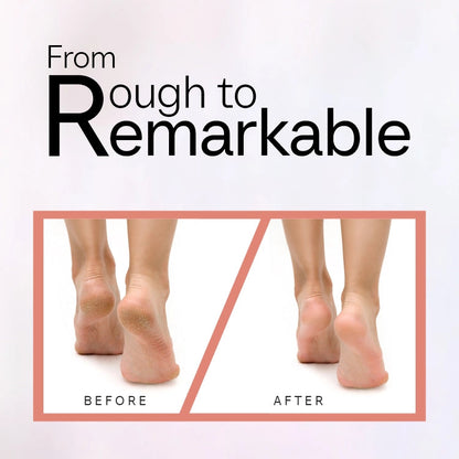 Electronic Callus Remover